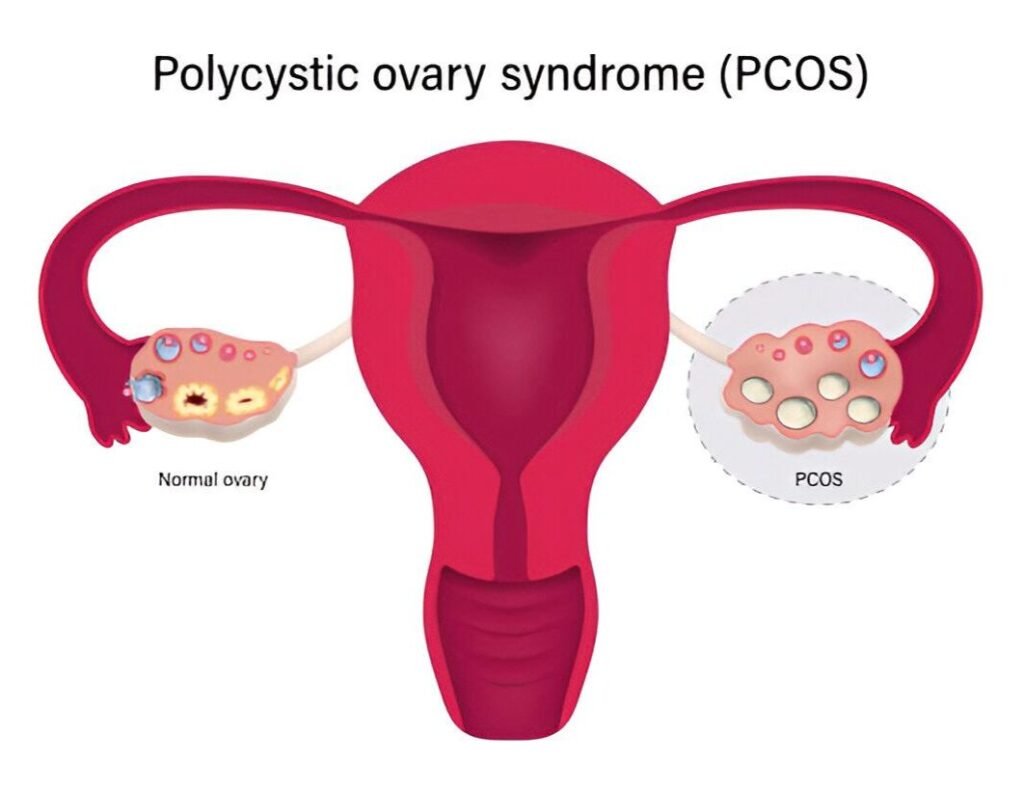 Ayurvedic clinic for PCOS in Pune. We provide the Holistic Ayurvedic treatment for PCOS in Pune, focusing on restoring hormonal balance, detoxifying the body, and improving overall reproductive health. 